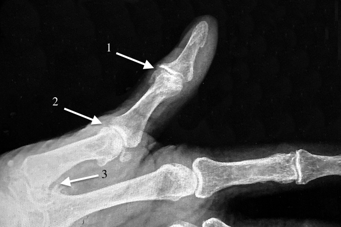 Osteoarthritis Fingerthumb Mp Pip Dip And Ip Hand Surgery Resource